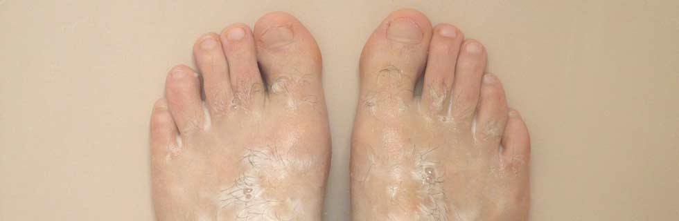 Skin peeling on deals feet after shower